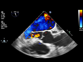 Screen of echocardiography (ultrasound) machine.