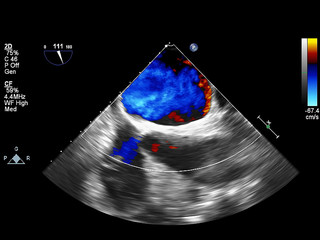 Screen of echocardiography (ultrasound) machine.