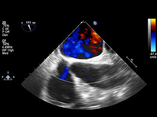 Screen of echocardiography (ultrasound) machine.