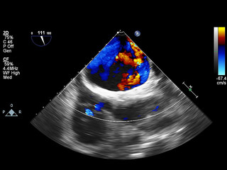 Screen of echocardiography (ultrasound) machine.