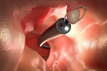 endoscope remove colonic polyp - obrazy, fototapety, plakaty