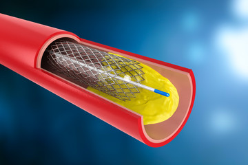 Balloon angioplasty procedure
