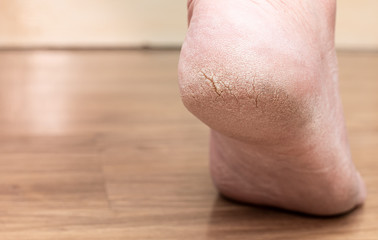 Closed-up of cracked heels, also known as fissures, a common foot problem