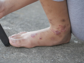 Close up image of itchy scratched wounded feet