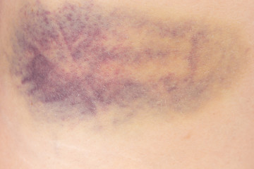 Hematoma on a woman thigh after a bruise or contusion - obrazy, fototapety, plakaty