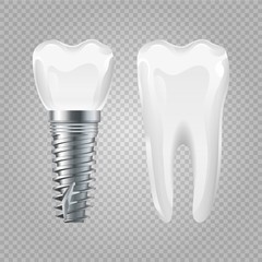 Dental implant. Realistic healthy tooth and implant. Vector dental surgery elements. Tooth and implant, mouth medicine and healthy treatment illustration