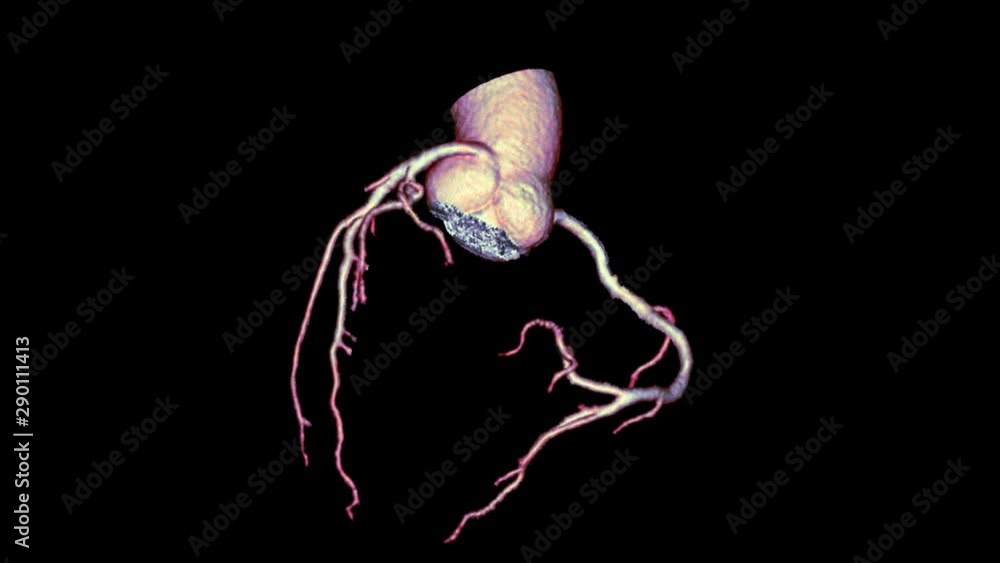 Poster cta coronary artery 3d rendering image or coronary tree turn around on the screen for diagnosis of v