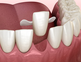 Maryland bridge made from ceramic, front tooth recovery. Medically accurate 3D illustration of dental concept