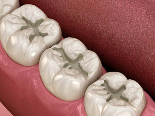 Prepareted Molar Fissure for fillings placement, Medically accurate 3D illustration of dental concept