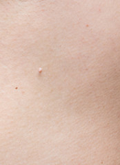 Fototapeta premium Pedunculated skin tag or acrochondon or soft fibroma. papilloma on human skin. Wart. Dermatological problem.mole on body , removal of moles nevus or warts concept