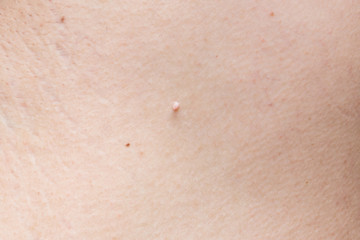 Pedunculated skin tag or acrochondon or soft fibroma. papilloma on human skin. Wart. Dermatological problem.mole on body , removal of moles nevus or warts concept