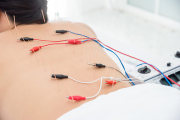 Asian woman receiving acupuncture with electrical stimulator at back ,Alternative medicine concept. - obrazy, fototapety, plakaty