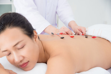 Beautiful asian woman receiving back acupuncture with electrical stimulator at clinic ,Alternative medicine concept.