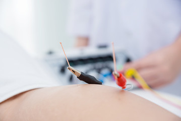 Closeup needle with electrical stimulator at Leg ,Alternative medicine concept.