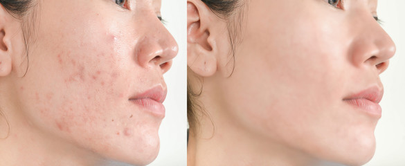 Before and After Retouch face and  Freckles  Woman  and skin problems  Facial Treatment Step