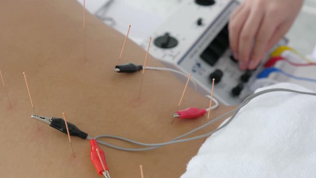 Close up woman undergoing acupuncture treatment with electrical stimulator on back