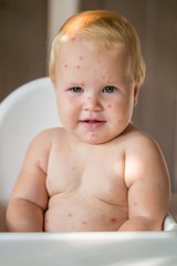 The child is sick with varicella. Measles. The child sits in a feeding chair and eats a banana.  