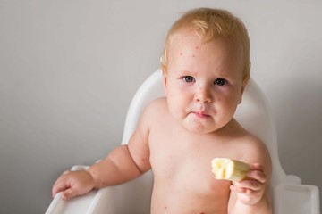 The child is sick with varicella. Measles. The child sits in a feeding chair and eats a banana....