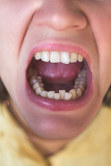 Photo of crooked woman teeth