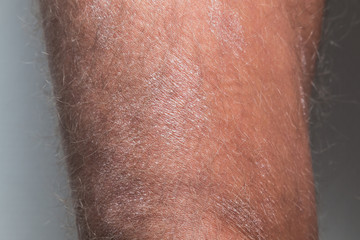 Naklejka premium Large plaque parapsoriasis on caucasian man legs