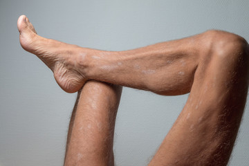 Fototapeta premium Large plaque parapsoriasis on caucasian man legs