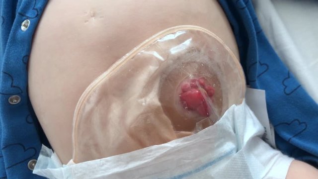 Close-up top view on transparent colostomy pouch attached to baby patient. Ostomy bag with filter. Colostomy surgery.