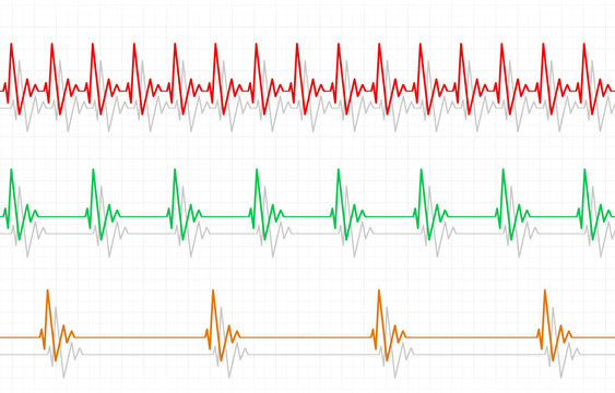Fast Normal Slow Pulse