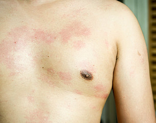 Fototapeta premium Ringworm on the body, skin infection that’s caused by mold.