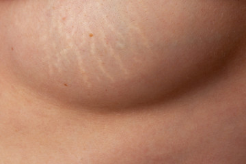 stretch marks on the breast of a young woman after childbirth