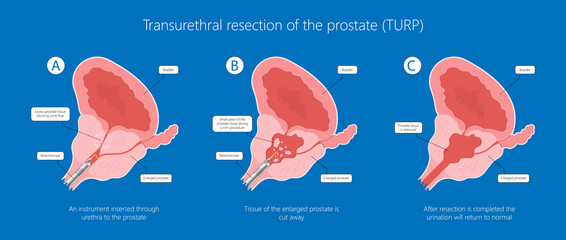 Transurethral resection of the prostate stricture urine bladder digital rectal exam specific antigen Gleason score biopsies Prostatitis test blood ultrasonography Radical Prostatectomy - obrazy, fototapety, plakaty
