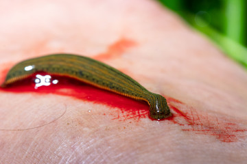 Aquatic Leech sucking blood on skin,Leeches were used in medicine from ancient