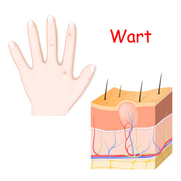 warts on a hand. cross section of detailed wart