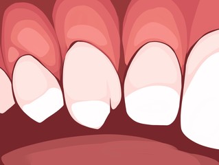 Necrotizing ulcerative gingivitis is a periodontal diseases