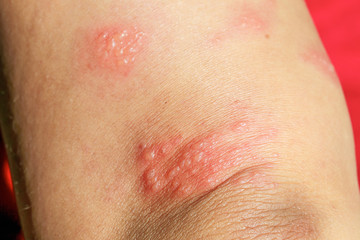 skin rash as allergic symptoms due to arm fiberglass cast - obrazy, fototapety, plakaty