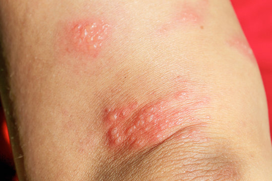 skin rash as allergic symptoms due to arm fiberglass cast