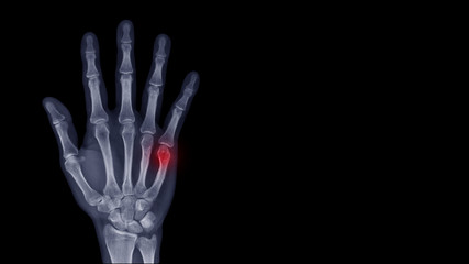 Film X-ray hand radiograph show finger bone broken (fifth metacarpal fracture or Boxer's fracture)...
