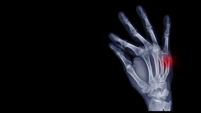 Film X-ray hand radiograph show hand bone broken (fifth metacarpal fracture or Boxer's fracture) from traffic accident. Highlight on fracture site and painful area. Medical imaging concept 