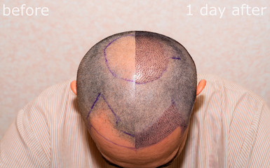 Before and after hair transplant surgery with a receding hair line. Bald head of hair loss...