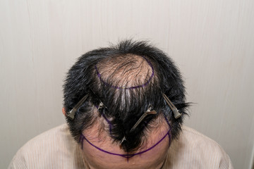 Mark Point of receding hair line for hair transplant surgery. Bald head of hair loss treatment.