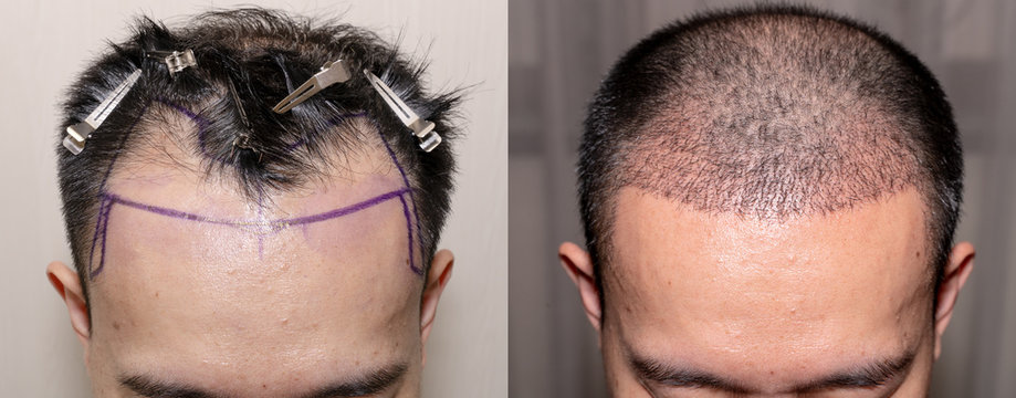 Top View Of A Man's Head With Hair Transplant Surgery With A Receding Hair Line. - Before And After Bald Head Of Hair Loss Treatment.