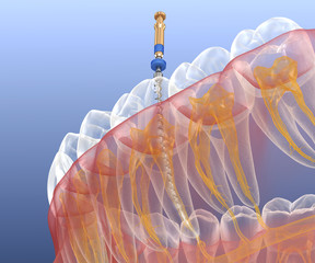 Endodontic root canal treatment process. Medically accurate tooth 3D illustration.