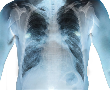 Close up Human Chest x-ray finding Cardiomegaly. Isolated background