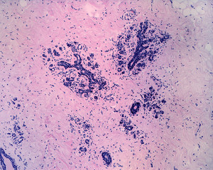 Human breast adenosis