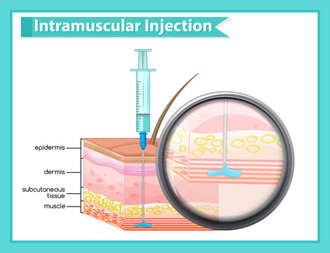 Scientific medical illustration of intramuscular injection