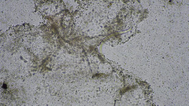 Strongyloides stercoralis larva in stool exam.Parasite in human.
