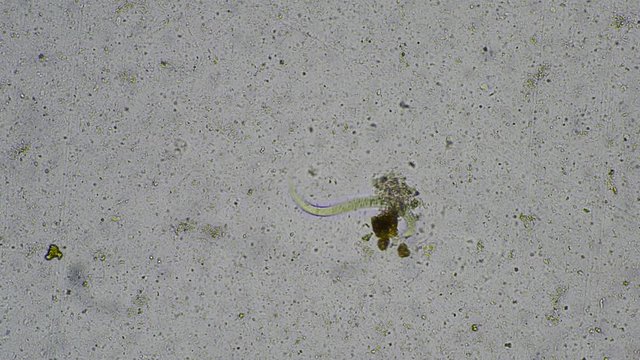 Strongyloides stercoralis larva in stool exam.Parasite in human.