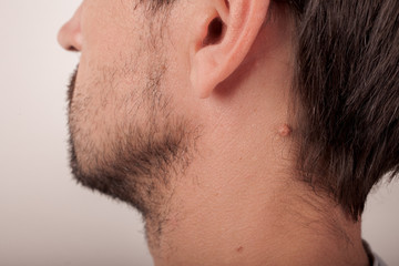 Adult man with moles on his neck - obrazy, fototapety, plakaty