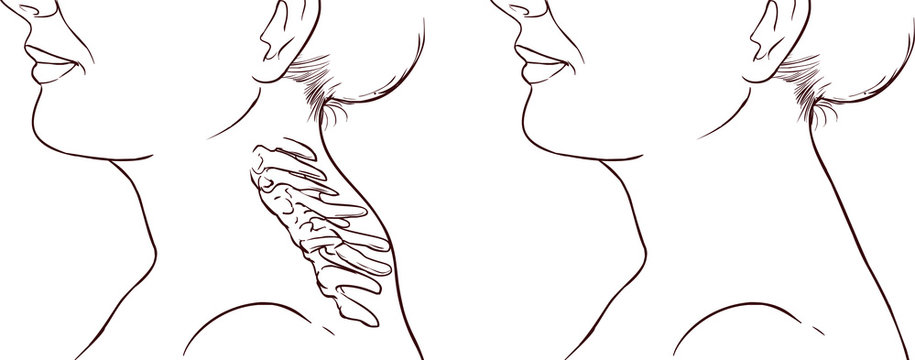 Woman Symptom Buffalo Hump Illustration