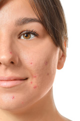 Young woman with acne problem on white background, closeup