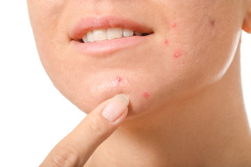 Young woman with acne problem on white background, closeup
